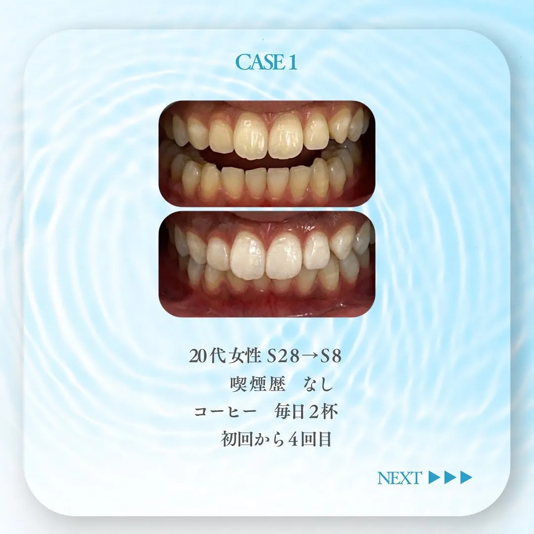 セルフホワイトニングの症例です✨🦷✨✨