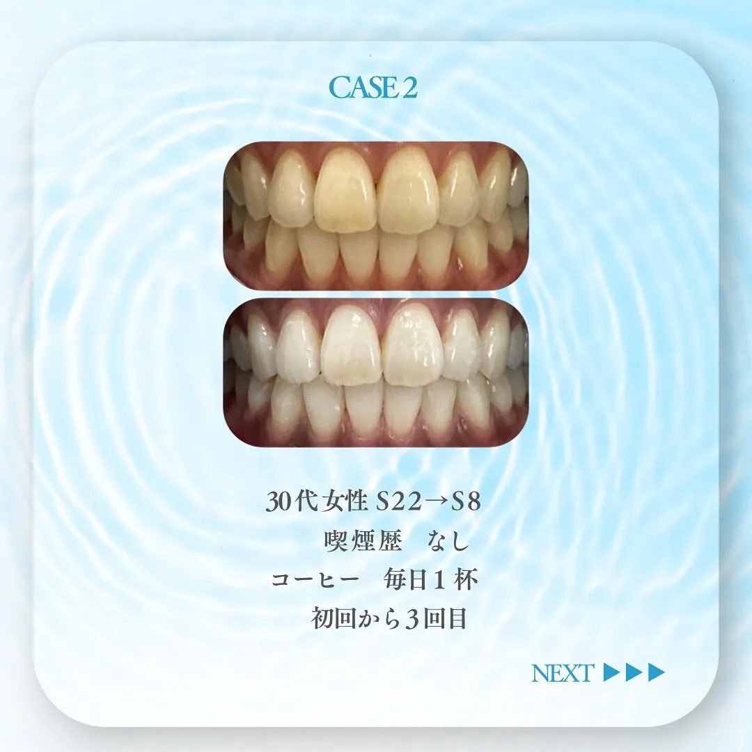 セルフホワイトニングの症例です✨🦷✨✨