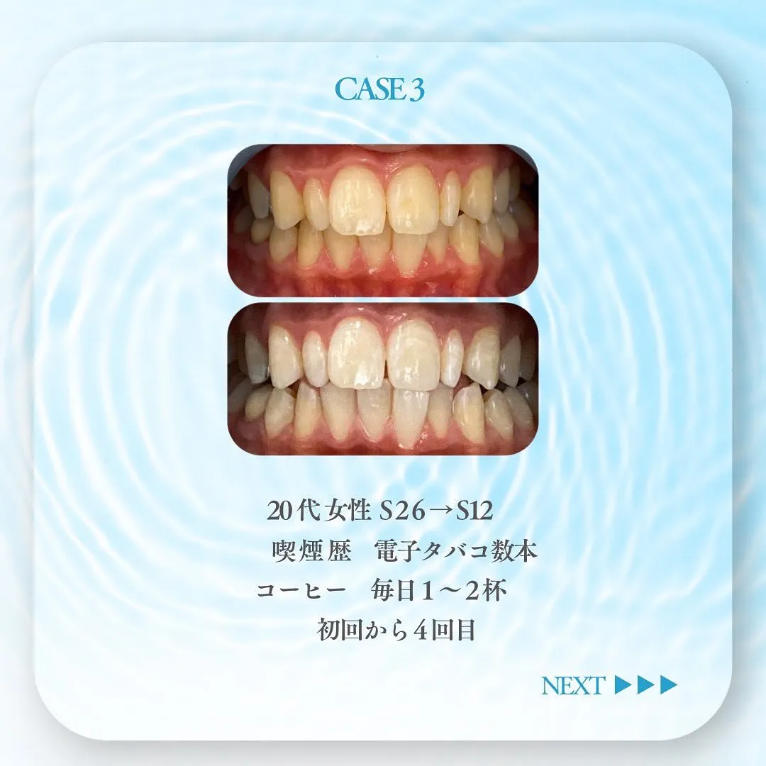 セルフホワイトニングの症例です✨🦷✨✨