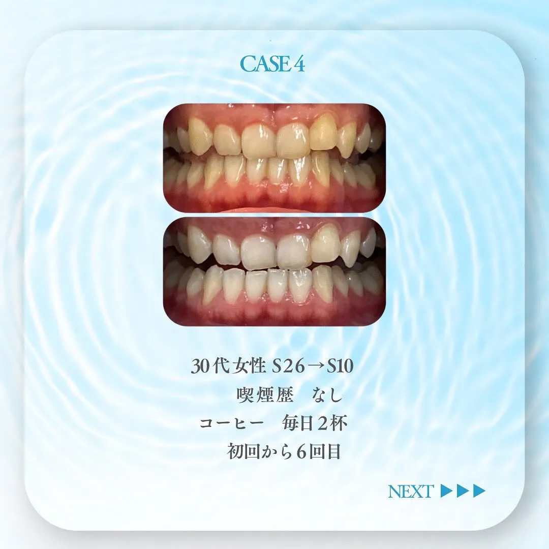 セルフホワイトニングの症例です✨🦷✨✨