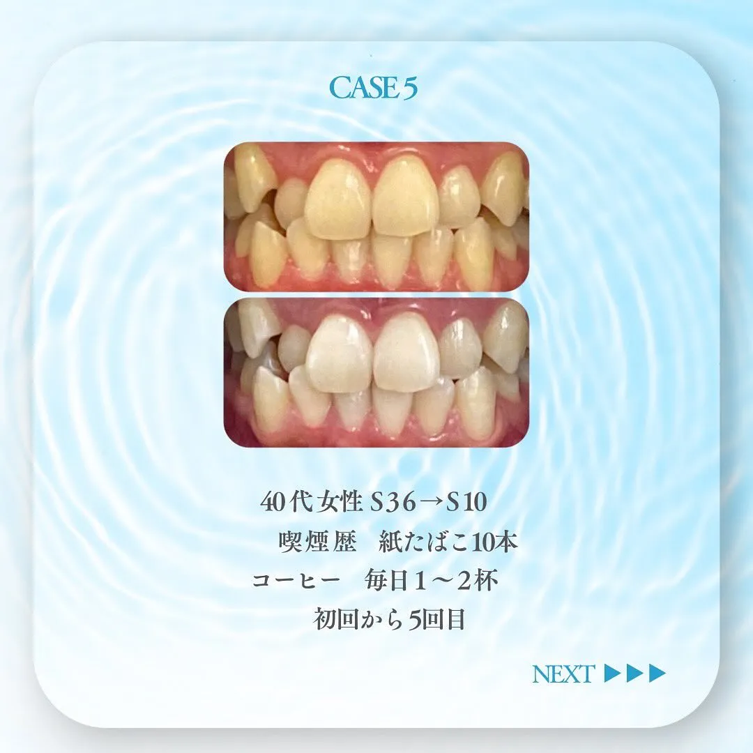 セルフホワイトニングの症例です✨🦷✨✨