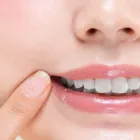 セルフホワイトニング